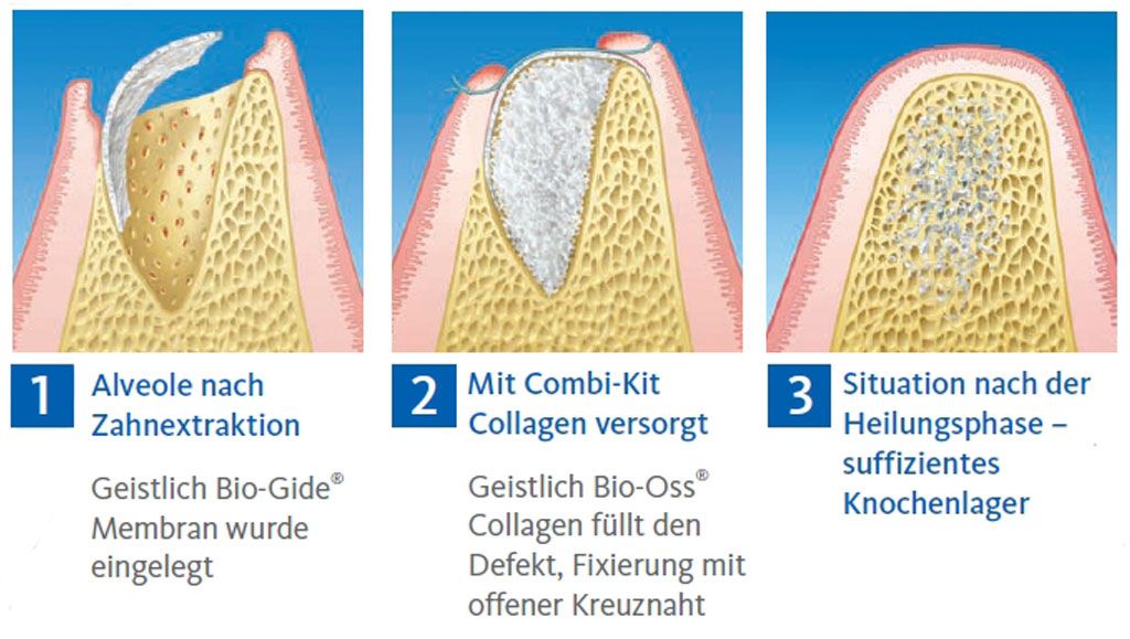 Guided bone regeneration - what are the advantages of this procedure? - Praxis Dr. med. Sven Heinrich Berlin Mitte