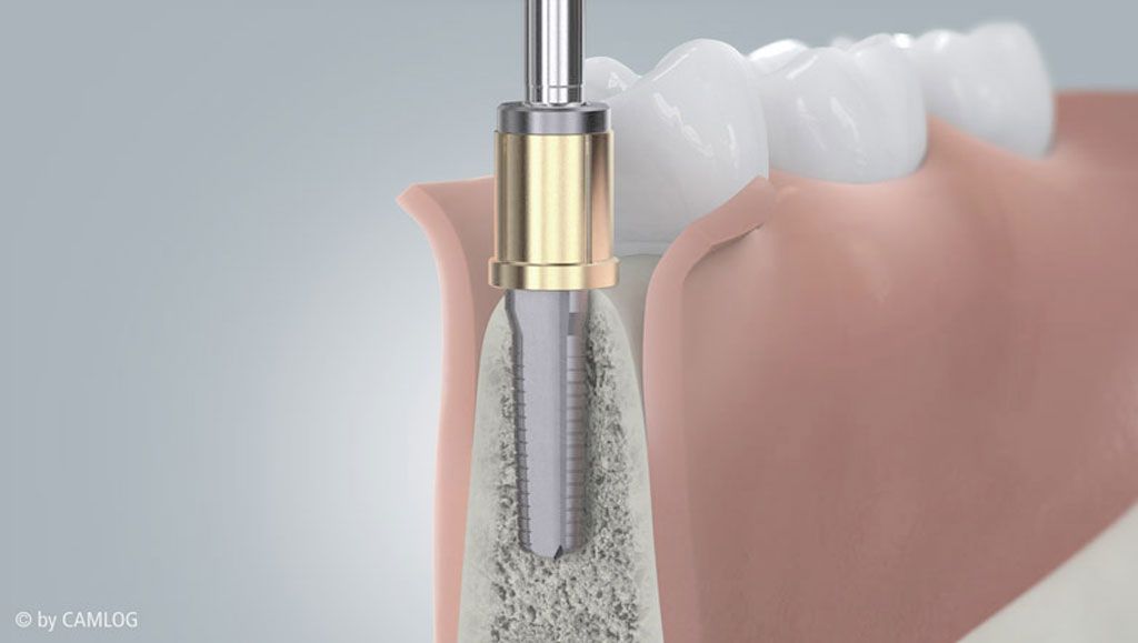 Dental implants - Close gaps with high-quality dental implants - Berlin Mitte Dr. med. Sven Heinrich