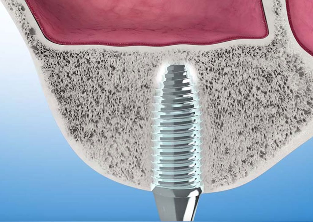 Knochenaufbau für Zahnimplantate 