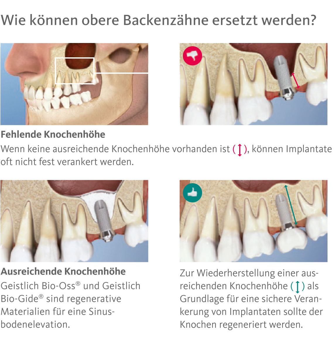 Bone augmentation for implant preparation - Sinuslift - Praxis Dr. med. Sven Heinrich Berlin Mitte