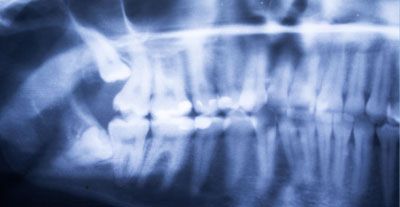 Wisdom teeth and displaced teeth - Dr. med. Sven Heinrich Berlin Mitte