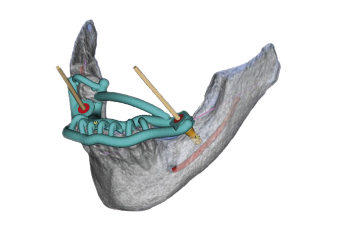 3D implant planning