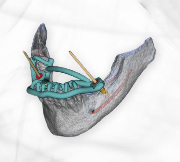 Navigated implantology - 3D implant planning - Dr. med. Sven Heinrich Berlin Mitte