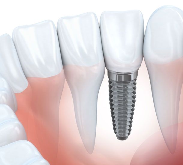 Implantology - Dental implants - Dr. med. Sven Heinrich Berlin Mitte