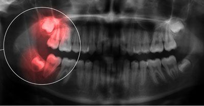 Wisdom teeth and displaced teeth - Practice Dr. Sven Heinrich - Berlin Mitte