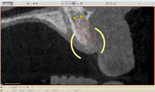 Presentation of the DICOM data (DVT); lateral view. The wax-up is displayed and the anatomical parameters are included in the planning.
