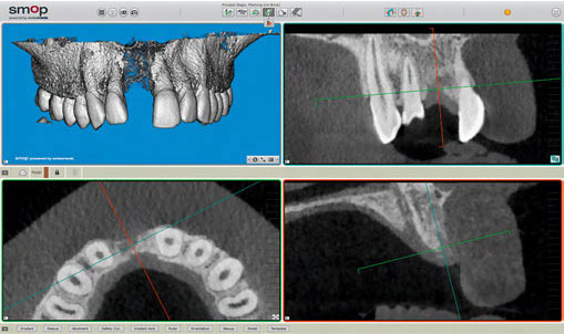 DVT-Aufnahme fünf Monate nach Zahnextraktion. Die DICOM-Daten werden in die Planungssoftware geladen, und die Okklusionsebene sowie das Knochenangebot werden evaluiert.